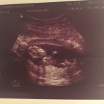 Baby Scan 13 weeks